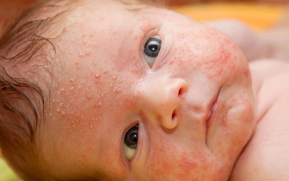 L'acné du nourrisson : est-ce grave ?